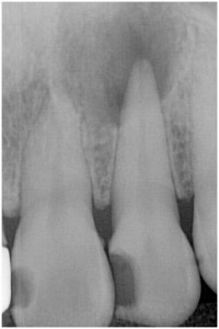 藤本1　歯髄壊死　◎